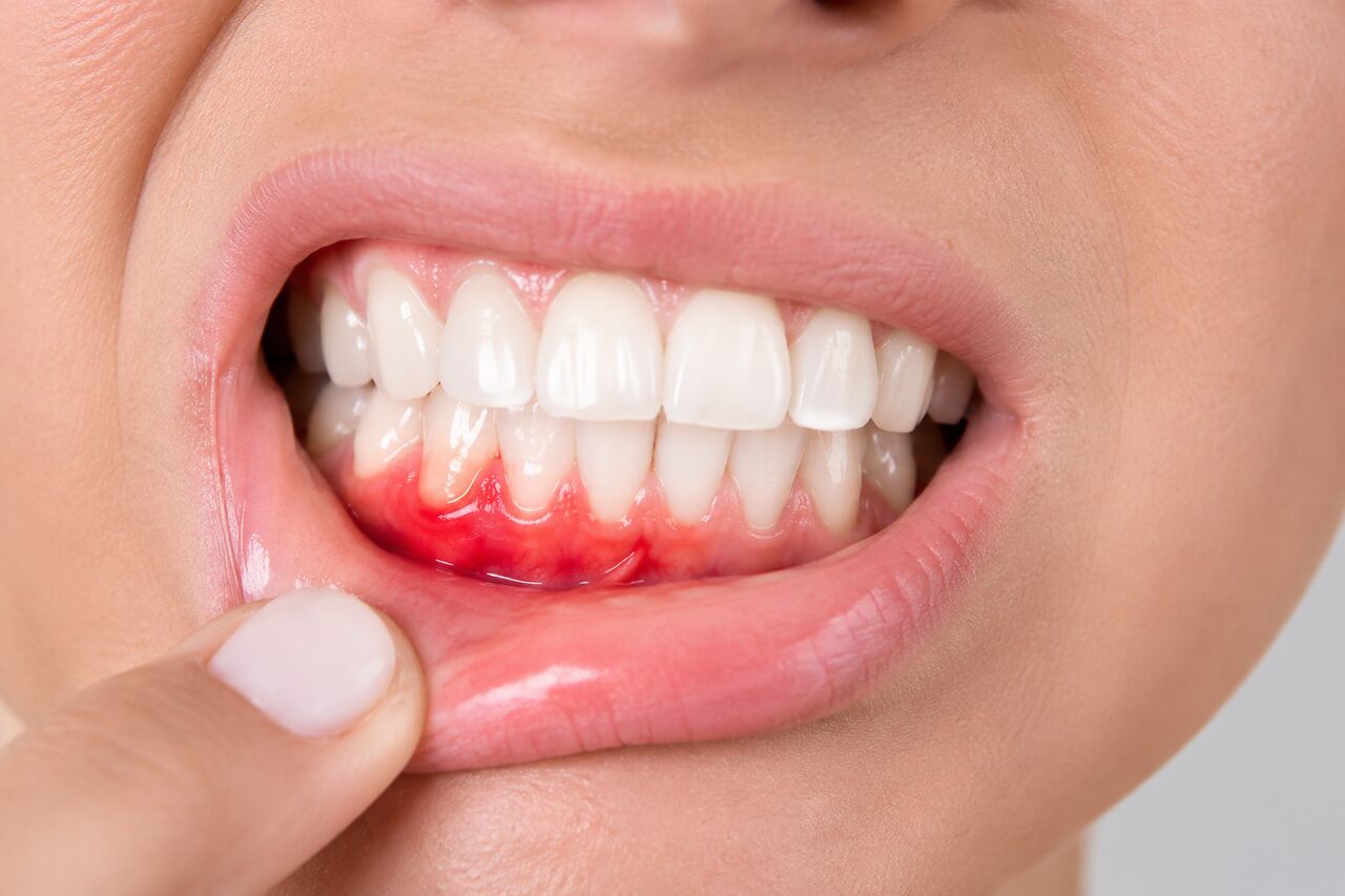 Hyderabad, Dental, Gum Surgery Treatment In Chintal &ndash; Advanced Periodontal Treatment For Healthy Gums