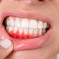 Gum Surgery Treatment In Chintal &ndash; Advanced Periodontal Treatment For Healthy Gums