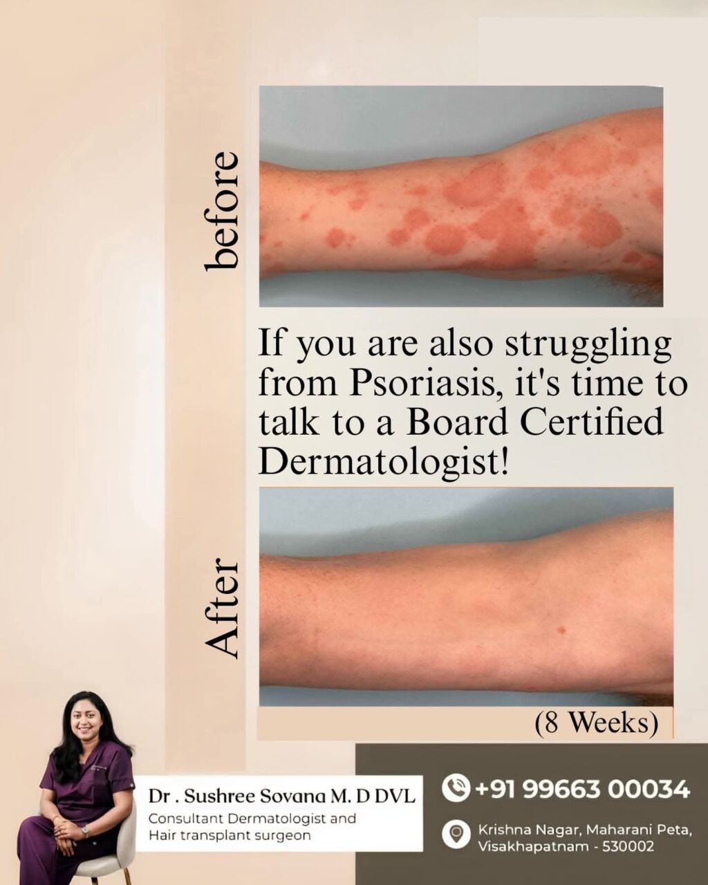 Visakhapatnam, Health, Signs Of Foot Psoriasis And Treatment- Dr Sushree Sovana