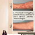 Signs Of Foot Psoriasis And Treatment- Dr Sushree Sovana