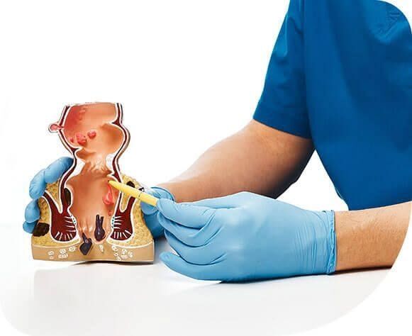 New Delhi, Health, Fistula Treatment In South Delhi