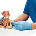 Fistula Treatment In South Delhi