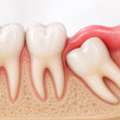 Wisdom Teeth Extraction In Nallagandla For Safe And Painless Removal