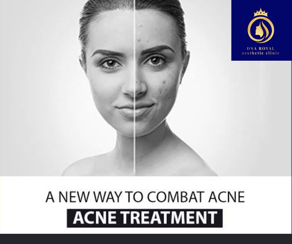 Thane, Fashion & Design, DNA Royal | Effective & Affordable Best Acne Treatment In Thane.