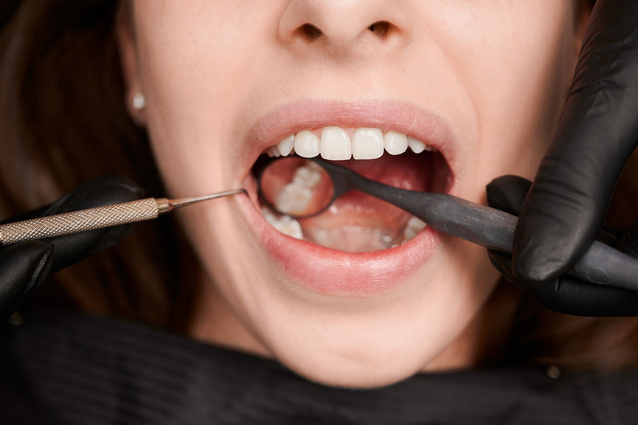 Sydney, Health, Best Damaged Tooth Treatment Service In Mickleham - Quality Dental Care Mickleham