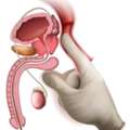 Vasectomy Services in Melbourne with Personalised Surgical Care