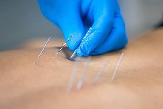 Gurgaon, Businesses For Sale, Dry Needling Services In Gurgaon &ndash; Expert Pain Relief & Muscle Recovery