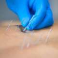 Dry Needling Services In Gurgaon &ndash; Expert Pain Relief & Muscle Recovery