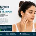 INR 5000,  White Patches On Face? Consult A Vitiligo Specialist Jaipur