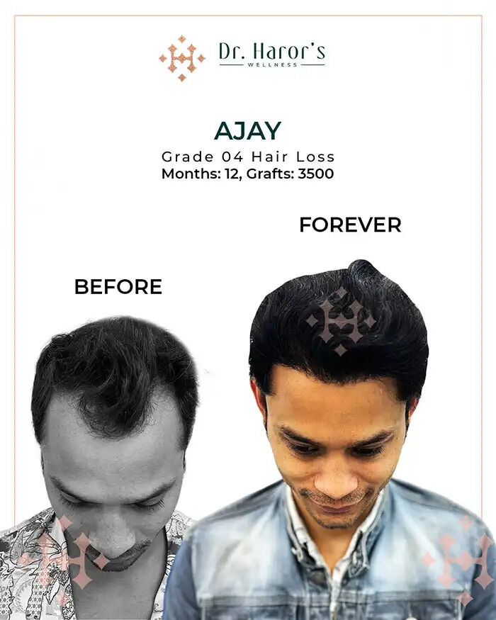 New Delhi, Health, See It To Believe It &mdash; Real Hair Transplant Before And After Stories