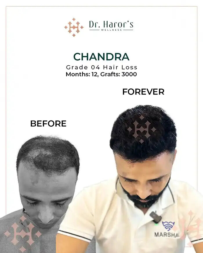 New Delhi, Health, See It To Believe It &mdash; Real Hair Transplant Before And After Stories