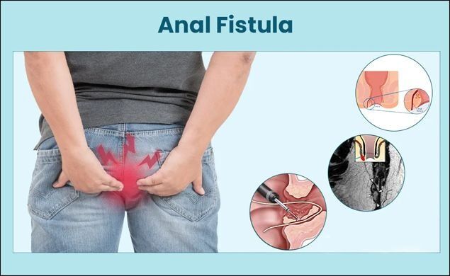 New Delhi, Health, Permanent Relief With Expert Ayurvedic Piles & Fissure Care In Delhi