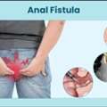 Permanent Relief With Expert Ayurvedic Piles & Fissure Care In Delhi