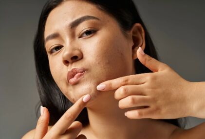 Nagpur, Health, Carbon Peel Laser Treatment In Nagpur For Clear & Radiant Skin