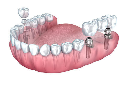 Gurgaon, Items Wanted, Dental Implants In Gurgaon | Restore Your Smile Naturally