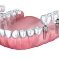 Dental Implants In Gurgaon | Restore Your Smile Naturally