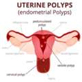 Hysteroscopy Procedure Cost In Delhi - Dr Rhythm Gupta