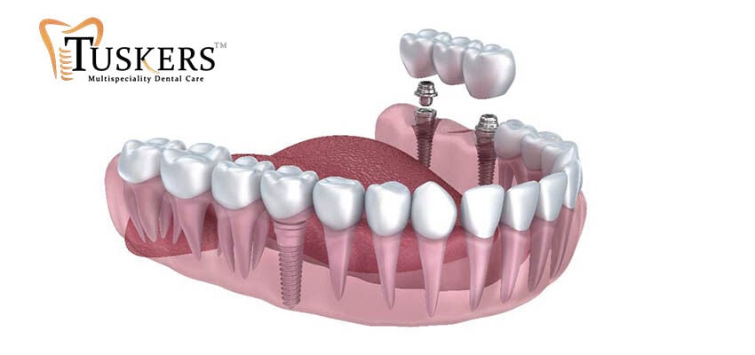 Ahmedabad, Health, Best Dentist In CG Road