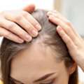 Scalp Micropigmentation: A Natural Solution For Thinning Hair And Baldness