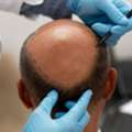 Hair Transplant Service Bhubaneswar