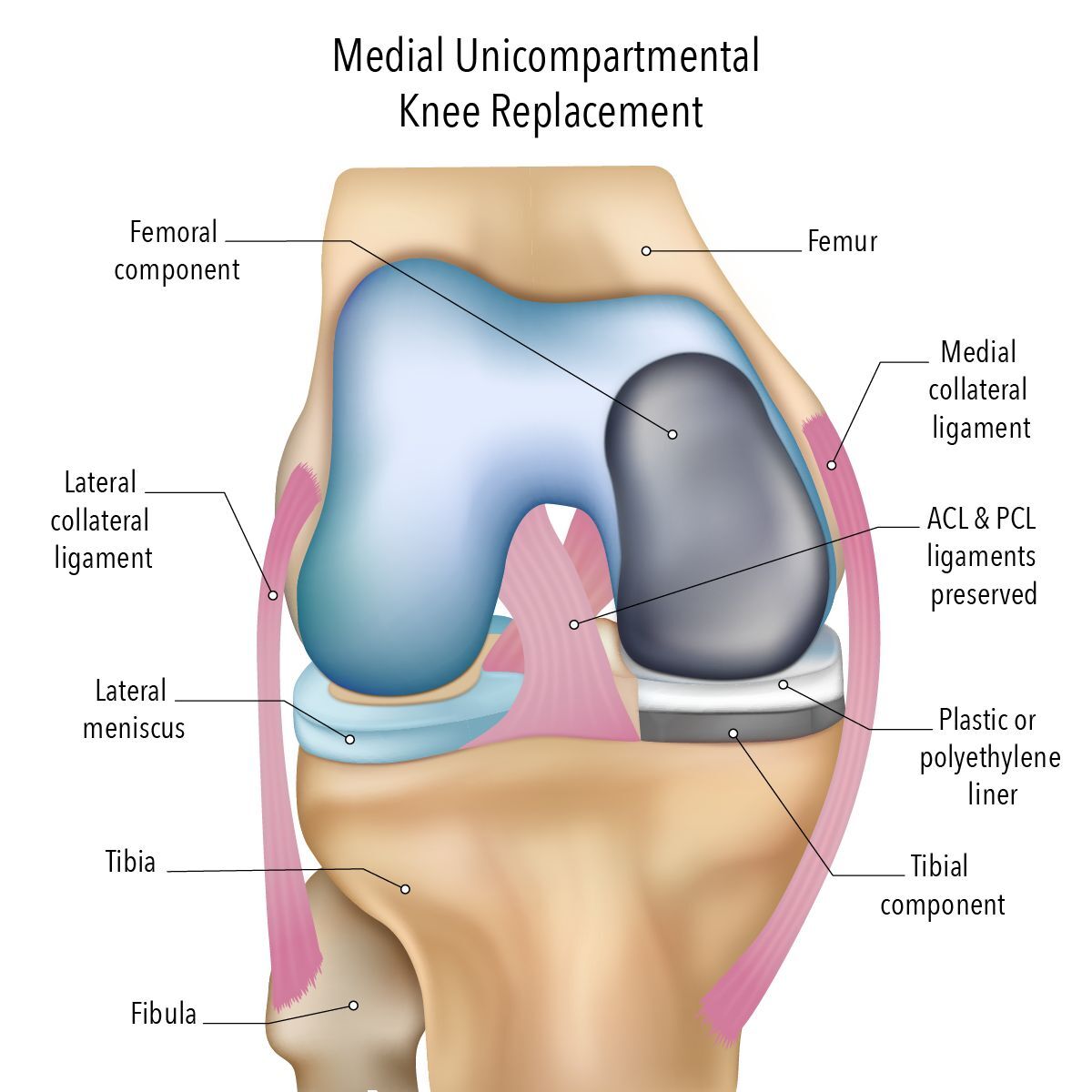 Melbourne, Health, Partial Knee Replacement Surgery For Damaged Knee Compartments