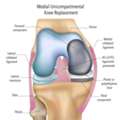 Partial Knee Replacement Surgery For Damaged Knee Compartments
