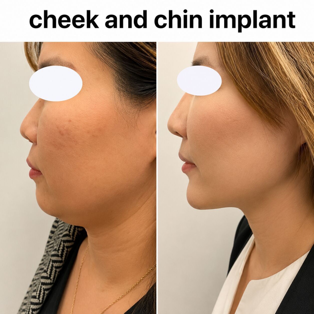 New York, Beautician, Surgical Chin Augmentation For Balanced Facial Features