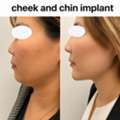 Surgical Chin Augmentation For Balanced Facial Features