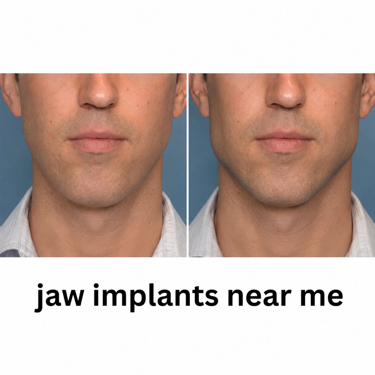 New York, Health, Jaw Augmentation Surgery For A Stronger Jawline