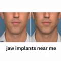 Jaw Augmentation Surgery For A Stronger Jawline