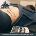 Dry Needling In Hampton Cove | Apex Chiropractic & Functional Wellness
