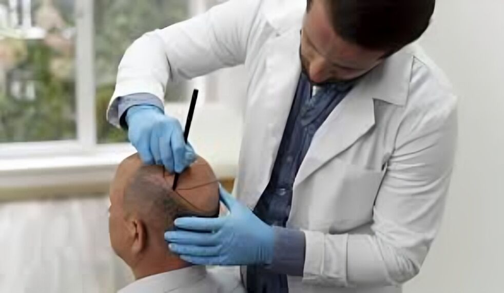 New Delhi, Health, From Receding To Remarkable &mdash; Before And After Hairline Transplant Results