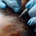Professional Hair Fall Growth Factor Treatment In Georgia