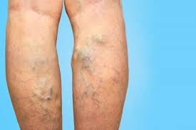 Sydney, Health, Spider Vein Treatment