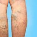 Spider Vein Treatment