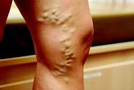 Sydney, Health, Spider Vein Treatment