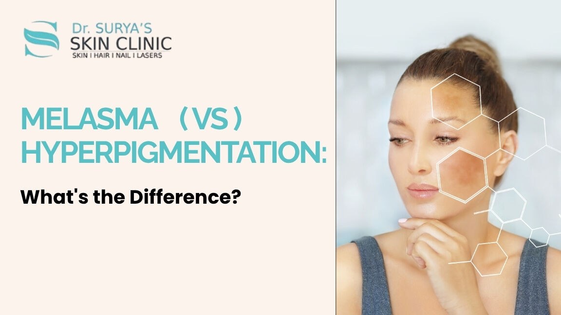 Mumbai, Health, Pigmentation Treatment In Secunderabad
