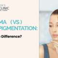 Pigmentation Treatment In Secunderabad