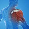 Shoulder Impingement In Gurgaon | Expert Physiotherapy For Lasting Shoulder Pain Relief
