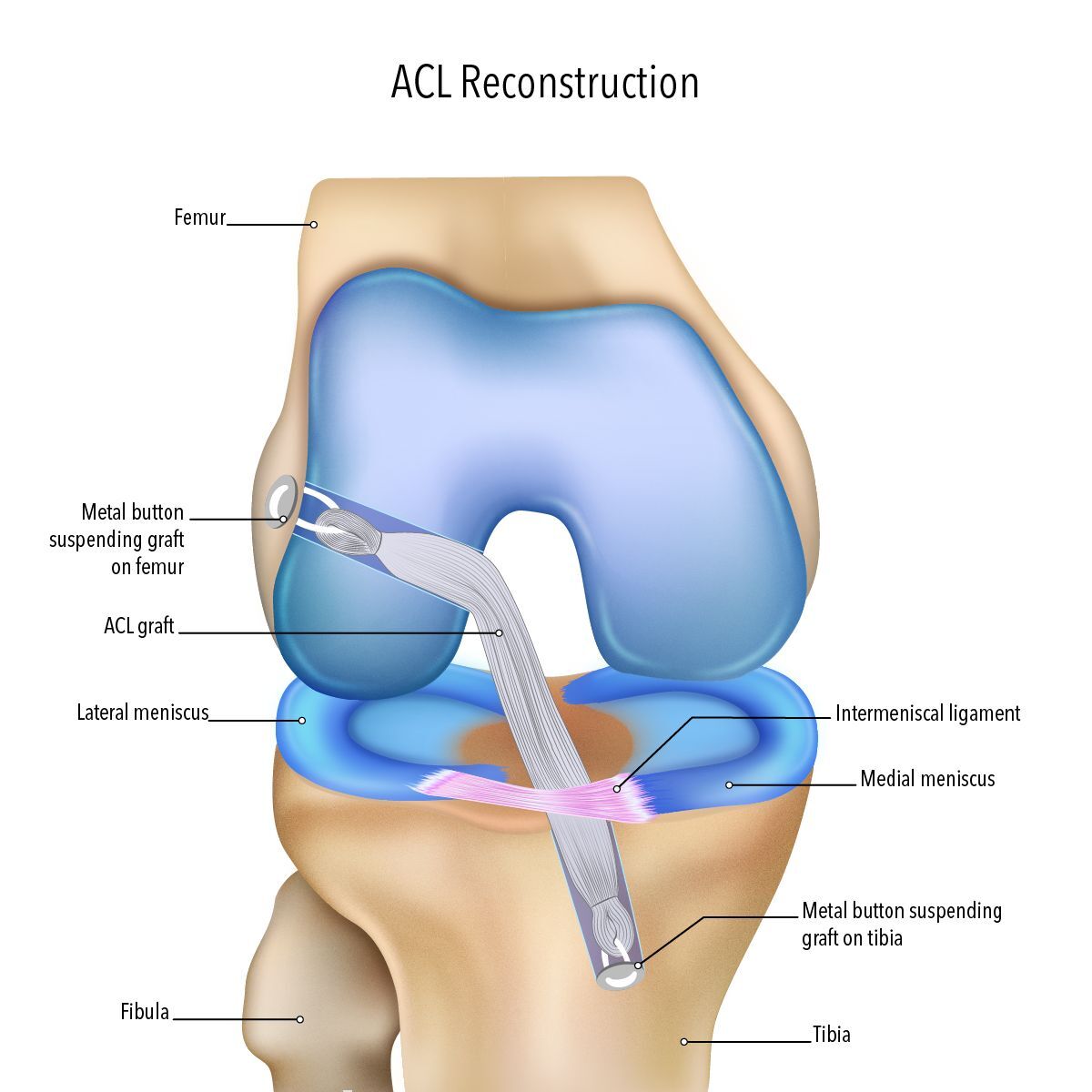Melbourne, Health, Torn ACL Surgery Begins With The Right Diagnosis