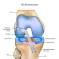 Torn ACL Surgery Begins With The Right Diagnosis