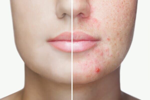 Dubai, Beautician, Perimenopause Skin Dubai | Expert Care For Healthy, Radiant Skin