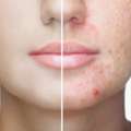 Perimenopause Skin Dubai | Expert Care For Healthy, Radiant Skin