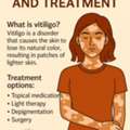 Best Vitiigo Treatment In Visakhapatnam