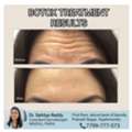Botox Results At Dermacure Clinic - Rajahmundry