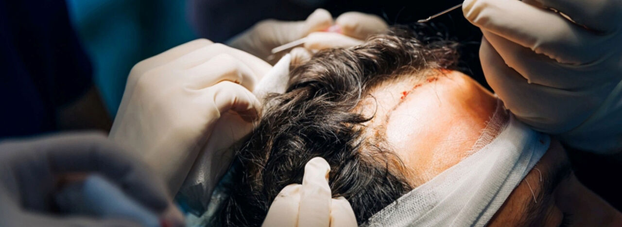 New Delhi, Health & Beauty Items, INR 50,  Precision Without The Premium Markup &mdash; FUE Hair Transplant Price That Surprises