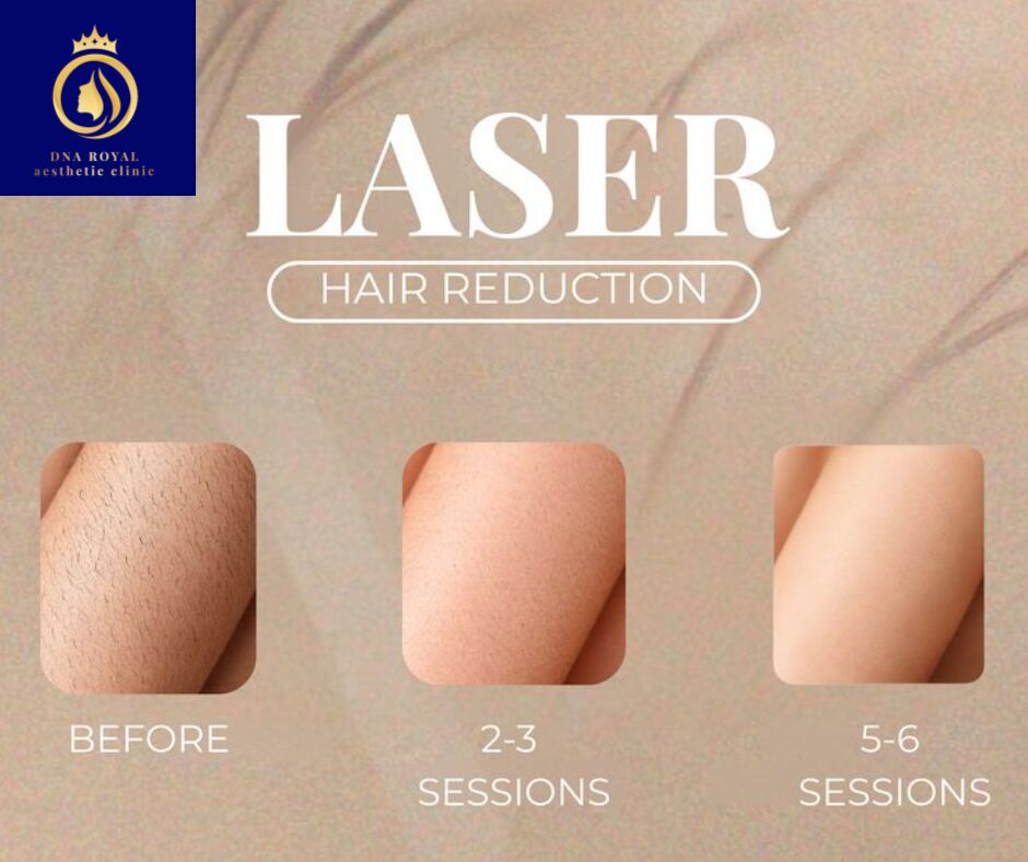 Thane, Fashion & Design, Experience The Best Laser Hair Removal In Thane With DNA Royal.