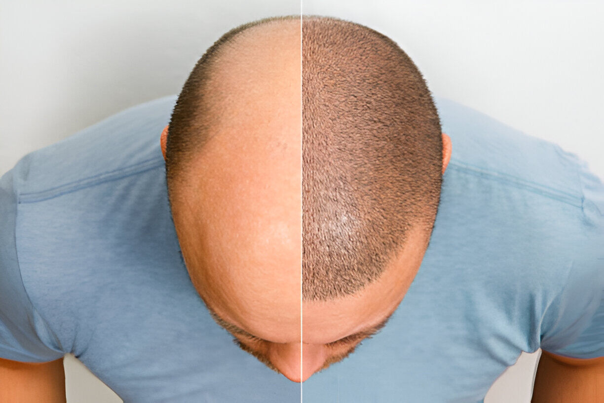 Bhopal, Health, Hair Transplant Price In Bhopal Starts At Affordable Cost | Bhopal Hair Clinic