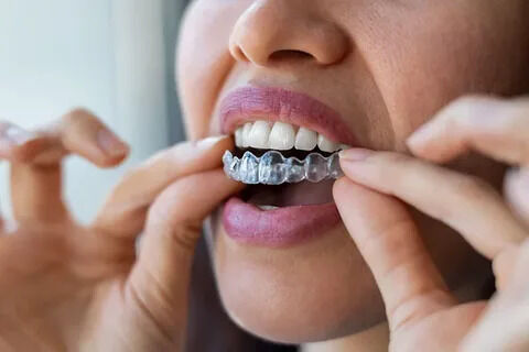 Pune, Dental, Clear Aligners In Pune | Invisible Teeth Aligners | DR. BILAL&rsquo;S DENTAL CLINIC