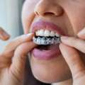 Clear Aligners In Pune | Invisible Teeth Aligners | DR. BILAL&rsquo;S DENTAL CLINIC